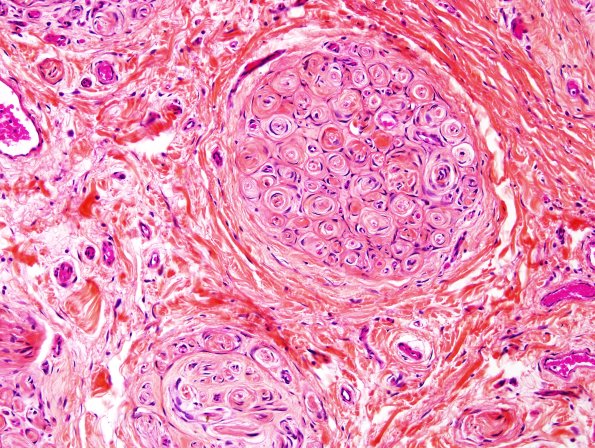 15A4 Perineurioma (Case 15) Pentachrome HPS 5.jpg