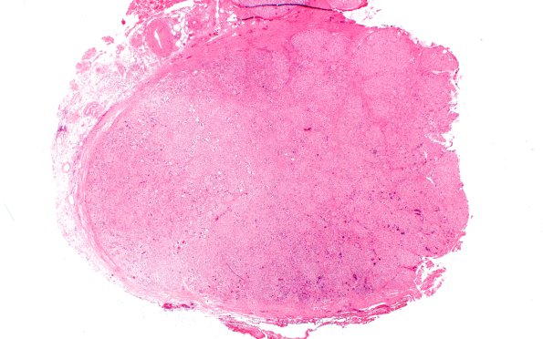 16A1 Bilat (Case 16) H&E 2X