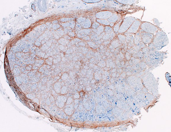 16B1 Bilat (Case 16) A1 EMA 2X 2