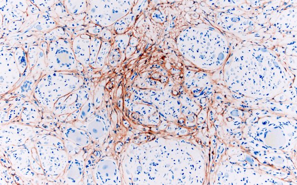 16B3 Bilat (Case 16) A1 EMA 20X