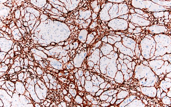 16C2 Bilat (Case 16) A1 GLUT1 20X 2