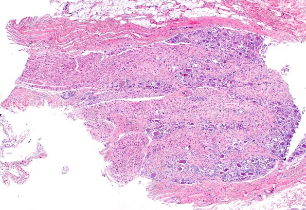 17A1 (Case 17) control DRG H&E 4X