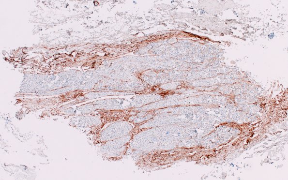 17B1 (Case 17) control DRG EMA 4X
