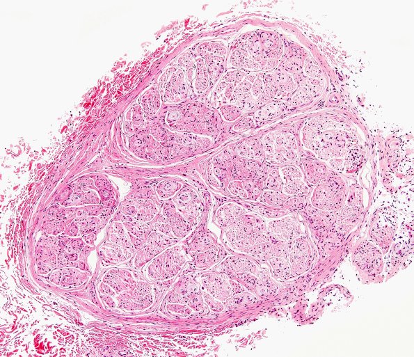 1A1 Perineurioma (Case 1) H&E 1.jpg