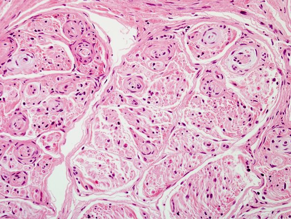 1A2 Perineurioma (Case 1) H&E 3.jpg