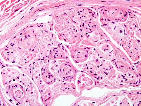 1A3 Perineurioma (Case 1) H&E 4.jpg