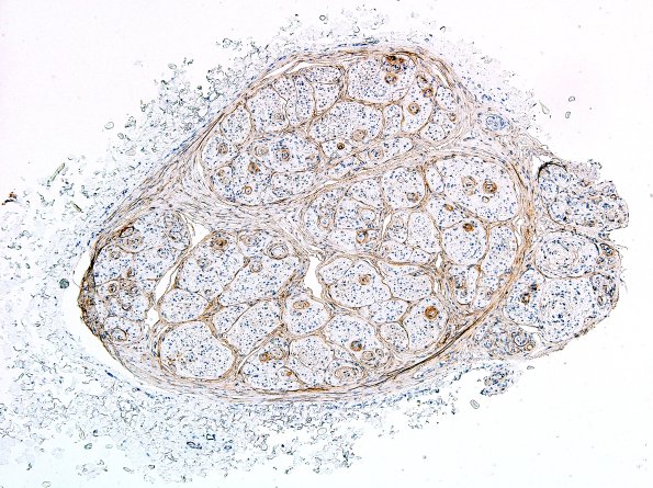 1B1 Perineurioma (Case 1) EMA 5.jpg