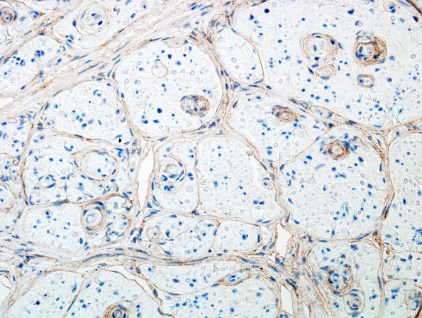 1B2 Perineurioma (Case 1) EMA 1 (2)