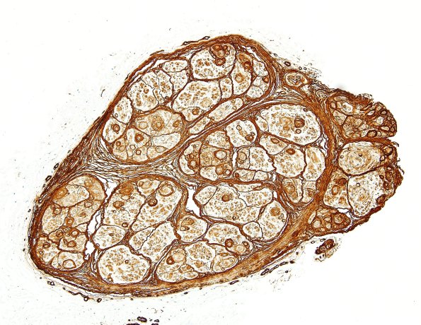 1C1 Perineurioma (Case 1) Coll IV 5.jpg