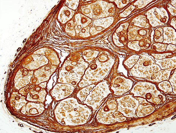 1C2 Perineurioma (Case 1) Coll IV 1 (2).jpg