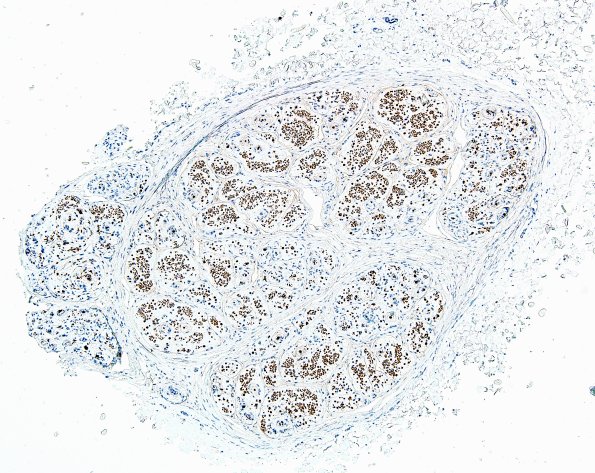 1D1 Perineurioma (Case 1) NF 4.jpg