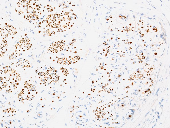 1D2 Perineurioma (Case 1) NF 1.jpg