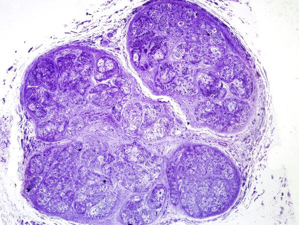 1E1 Perineurioma (Case 1) Plastic 2.jpg