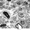 1F1 Perineurioma (Case 1) EM 1 - Copy