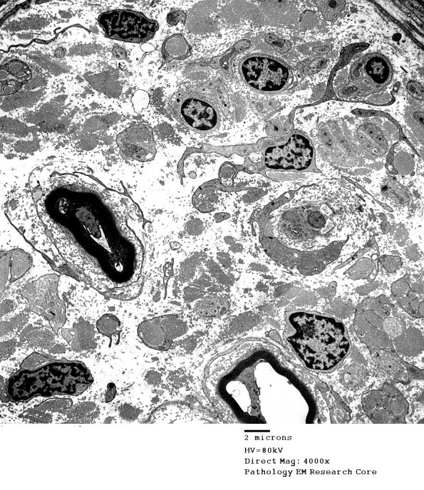 1F1 Perineurioma (Case 1) EM 1 - Copy