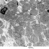 1F2 Perineurioma (Case 1) EM 4 - Copy