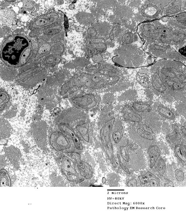 1F2 Perineurioma (Case 1) EM 4 - Copy