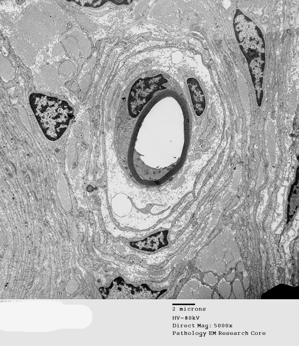 1F3 Perineurioma (Case 1) EM 5 - Copy