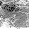 1F5 Perineurioma (Case 1) EM 2 - Copy