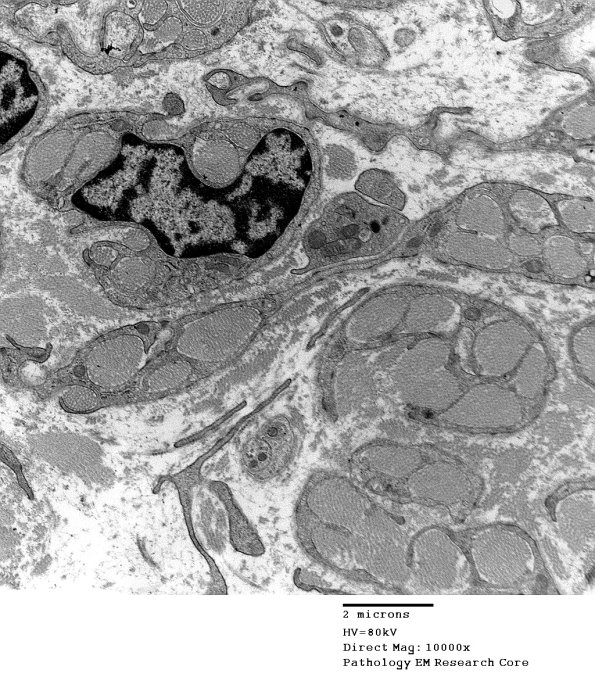 1F5 Perineurioma (Case 1) EM 2 - Copy