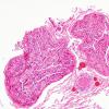 2A1 Perineurioma (Case 2) H&E 3.jpg