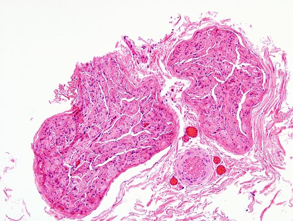 2A1 Perineurioma (Case 2) H&E 3.jpg