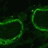 2B1 Perineurioma (Case 2) Control (EMA) - Copy