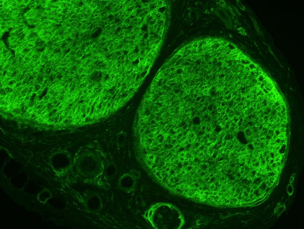 2B2 Perineurioma (Case 2) 14451ema - Copy