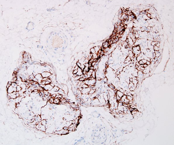 2C1 Perineurioma (Case 2) EMA 5.jpg