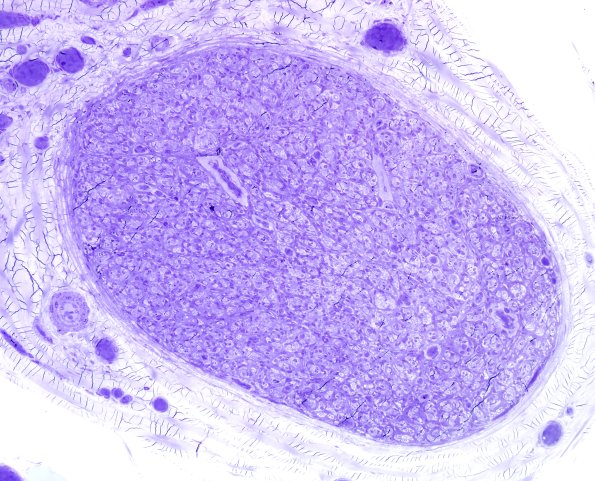 2E1 Perineurioma (Case 2) Plastic 5.jpg