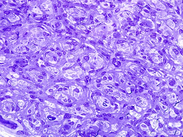 2E3 Perineurioma (Case 2) Plastic 2.jpg