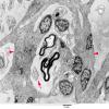 2F1 Perineurioma (Case 2) EM 068 copy A - Copy