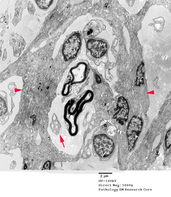 2F1 Perineurioma (Case 2) EM 068 copy A - Copy