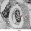 2F2 Perineurioma (Case 2) EM 055 copy - Copy