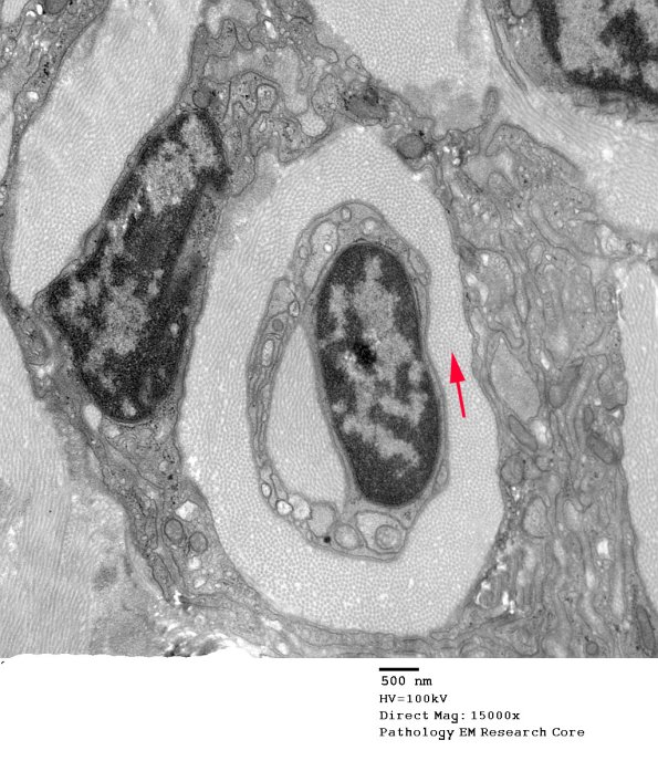 2F2 Perineurioma (Case 2) EM 055 copy - Copy