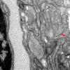 2F3 Perineurioma (Case 2) EM 057 copy - Copy