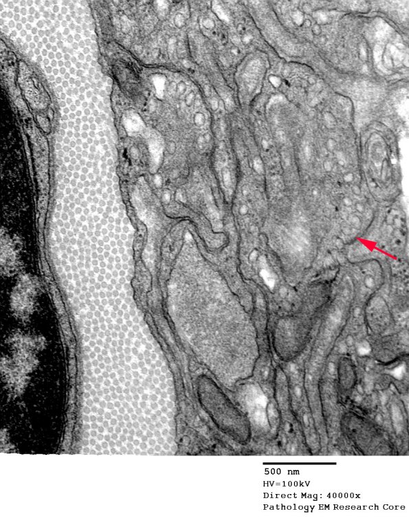 2F3 Perineurioma (Case 2) EM 057 copy - Copy