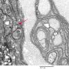 2F4 Perineurioma (Case 2) EM 079 copy - Copy