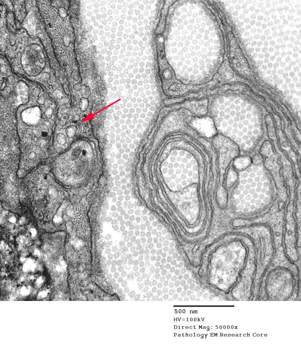 2F4 Perineurioma (Case 2) EM 079 copy - Copy