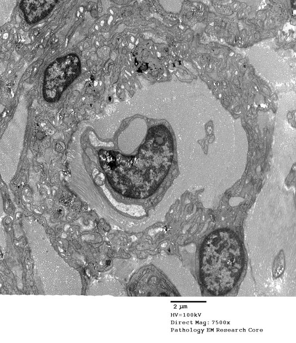 2F5 Perineurioma (Case 2) EM 031 - Copy