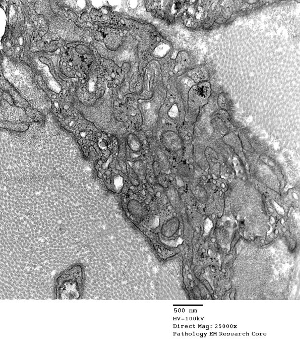2F6 Perineurioma (Case 2) EM 032 - Copy