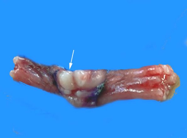 3A Perineurioma (Deep Peroneal nerve) (Case 3) copy