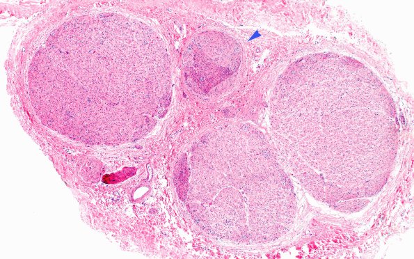 3B1 Perineurioma (Case 3) H&E 4XA copy.jpg