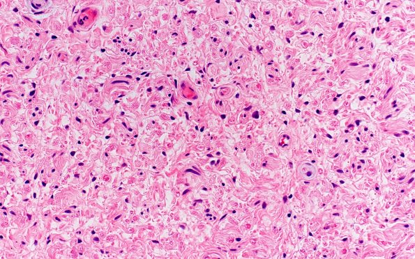 3B3 Perineurioma (Case 3) H&E 40X.jpg