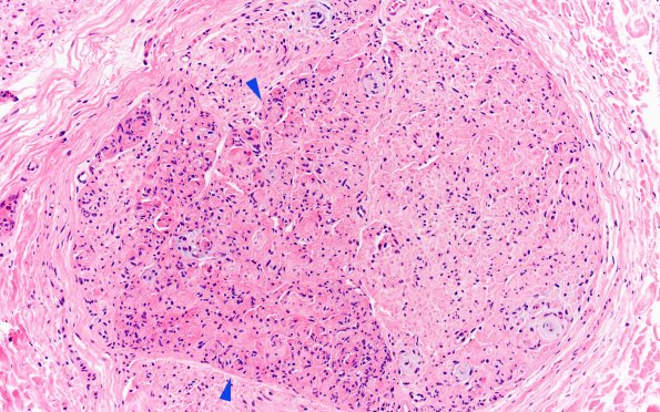 3B4 Perineurioma (Case 3) H&E 20X 2 copy.jpg