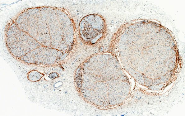 3C2 Half & Half Fascicle (Case 3) EMA 4X