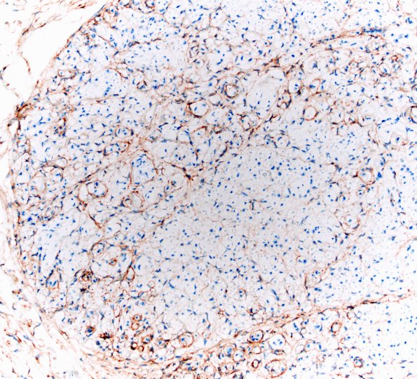 3C3 Perineurioma (Case 3) EMA 20X.jpg