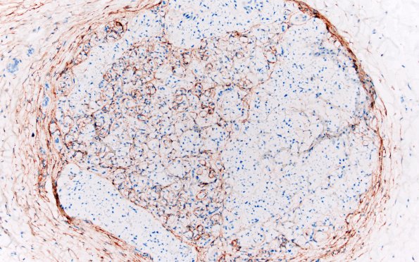 3C4 Perineurioma (Case 3) EMA 20X 2.jpg