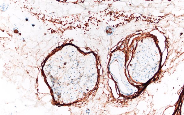 3D1 Half & Half Fascicle (Case 3) GLUT1 20X normal