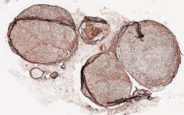 3D2 Half & Half Fascicle (Case 3) GLUT1 4X